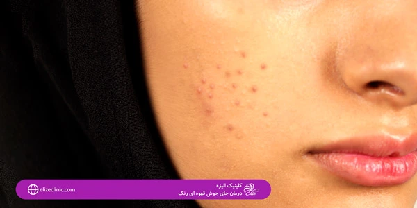 Treatment-of-brown-spots