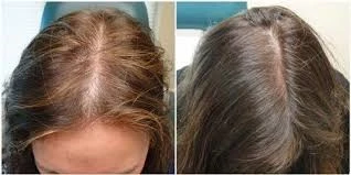 What-are-side-effects-hair-mesotherapy