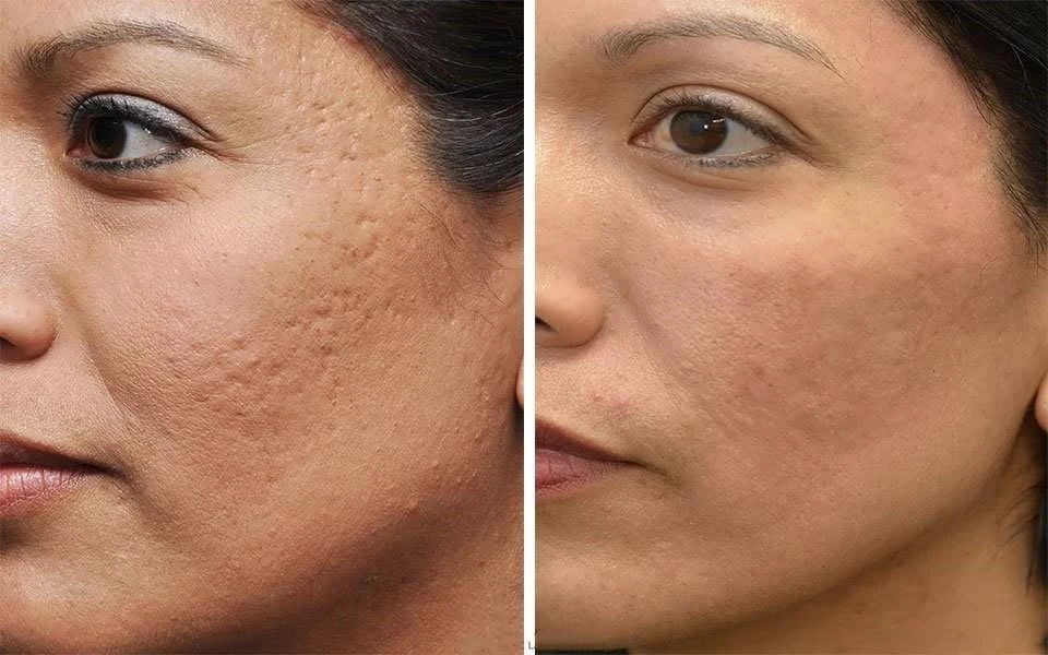 Treatment-facial-acne-traditional-medicine