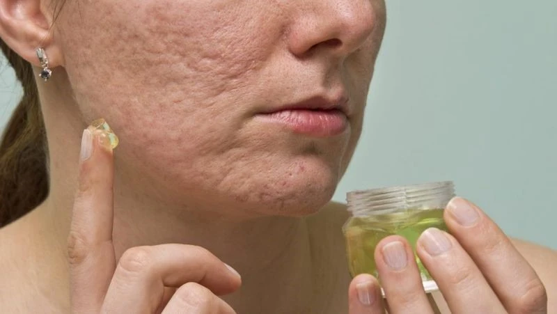 Treatment-Acne-scars