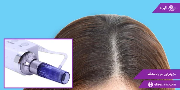 Hair-mesotherapy-with-the-device