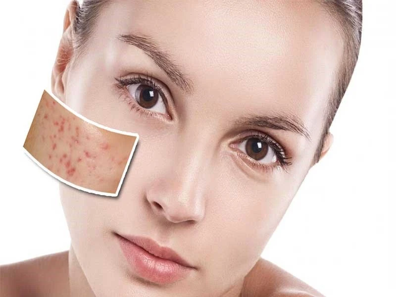 best-doctor-acne-treatment