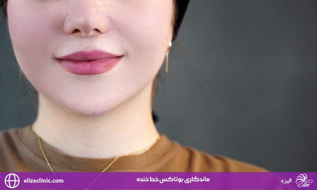 ماندگاری بوتاکس خط خنده