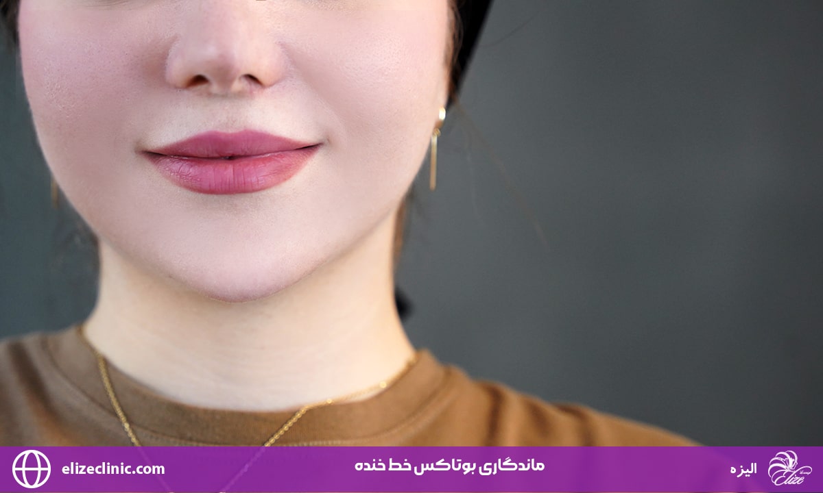 ماندگاری بوتاکس خط خنده
