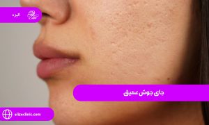 جای جوش عمیق 