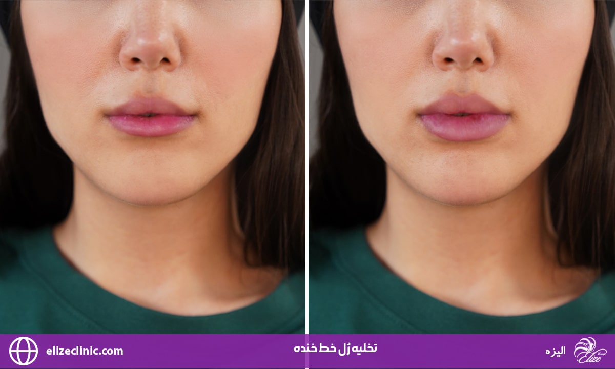 تخلیه ژل خط خنده