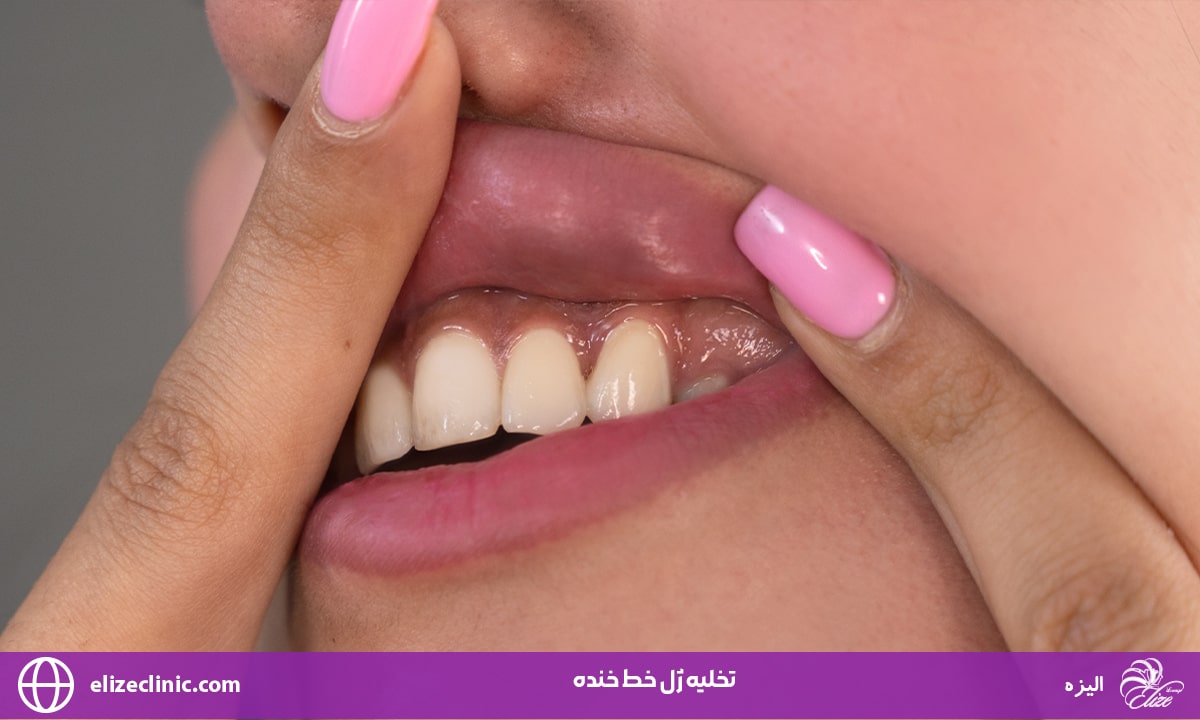 تخلیه ژل خط خنده