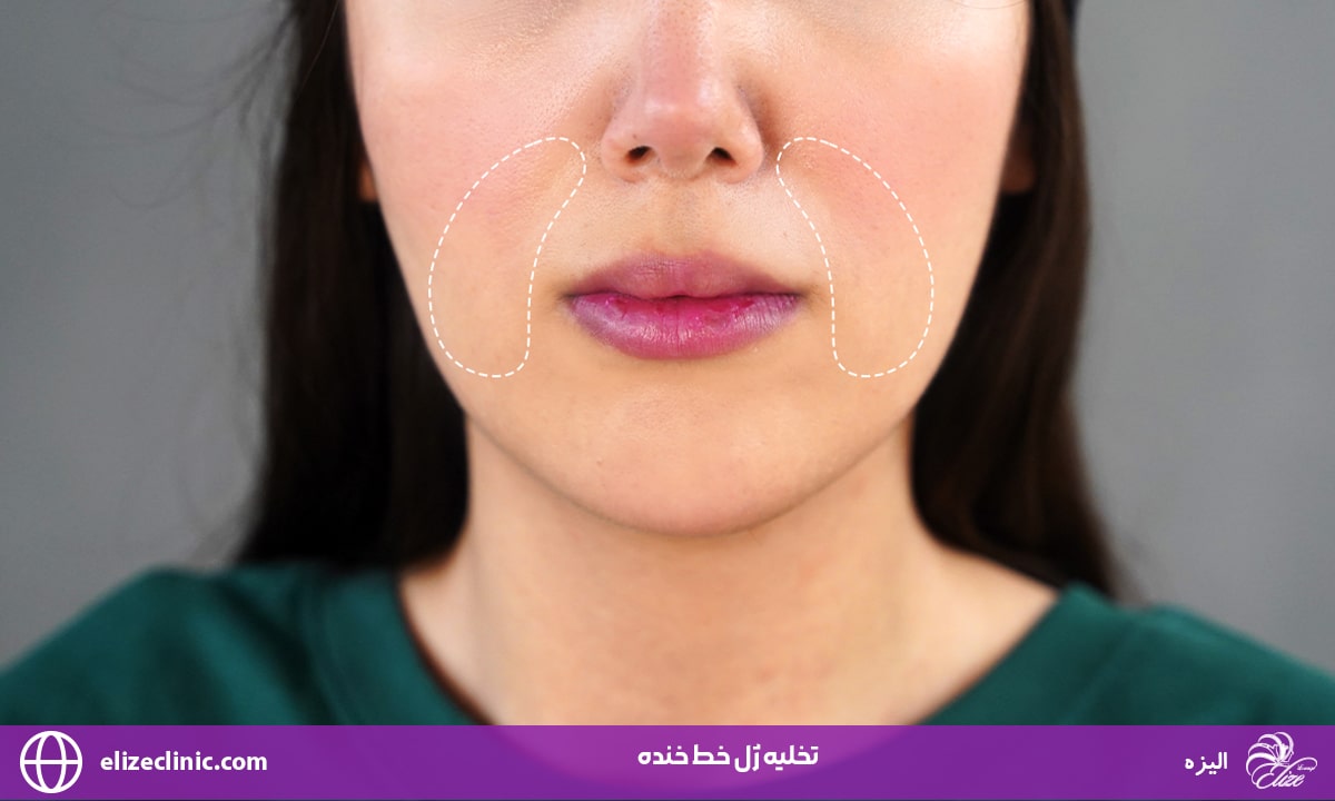 تخلیه ژل خط خنده