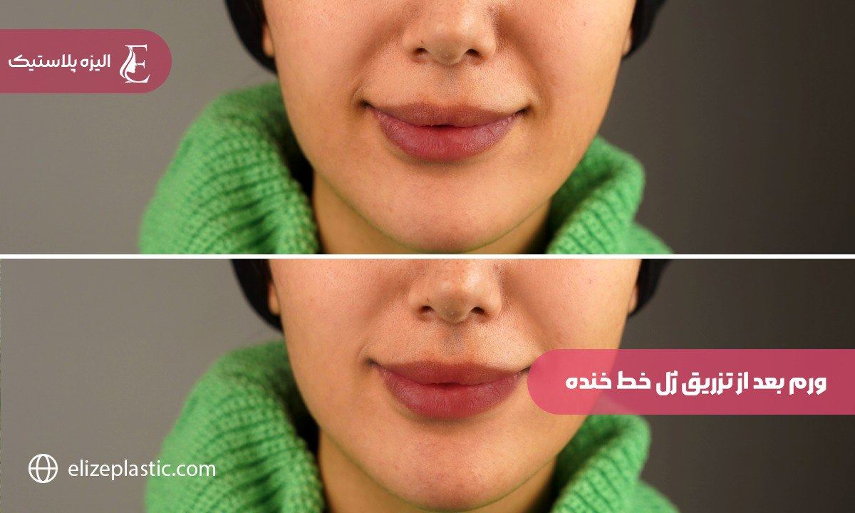 ورم بعد از تزریق ژل خط خنده